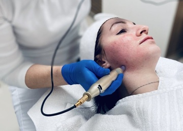 microneedling_v_praxi