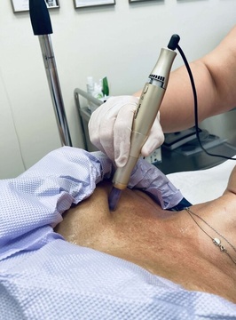 microneedling_na_dekoltu