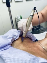 microneedling_na_dekoltu