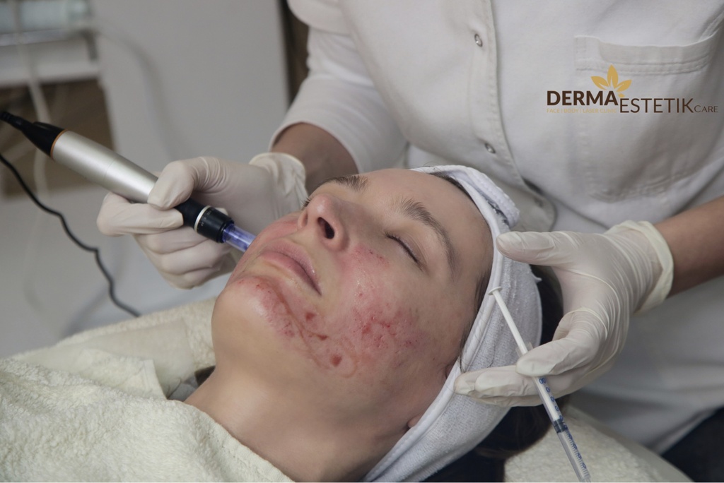 Microneedling - Tváře - jizvičky po akné